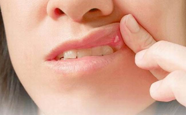 Las aftas bucales pueden no ser peligrosas, pero sí molestan 