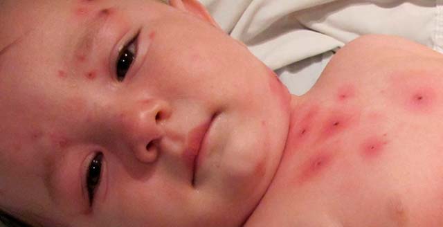 Niños europeos infectados por el sarampión, a causa de las erróneas decisiones de los padres y demás familiares. Niños europeos infectados por el sarampión, a causa de las erróneas decisiones de los padres y demás familiares.